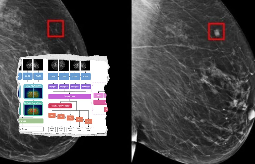MIT phát triển một mô hình AI phát hiện ung thư vú trước 5 năm